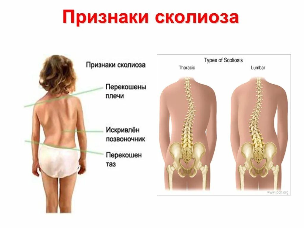 У ребенка в пояснице. Сколиоз позвоночника у детей и подростков. Искривлениепозвоничника. Искривление позвоночника сколиоз. Типы искривления позвоночника.