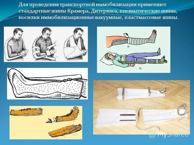 Иммобилизация предплечья при переломе голени. Иммобилизация предплечья при переломе голени