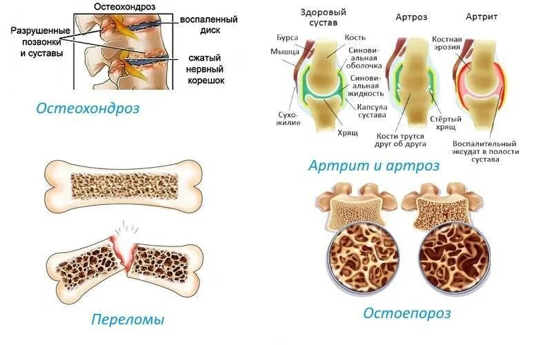 Артрит и артроз разница. Отличия артроз артрит остеохондроз. Остеохондроз остеопороз остеоартроз. Артрит артроз остеопороз. Остеохондроз остеопороз остеоартроз разница.