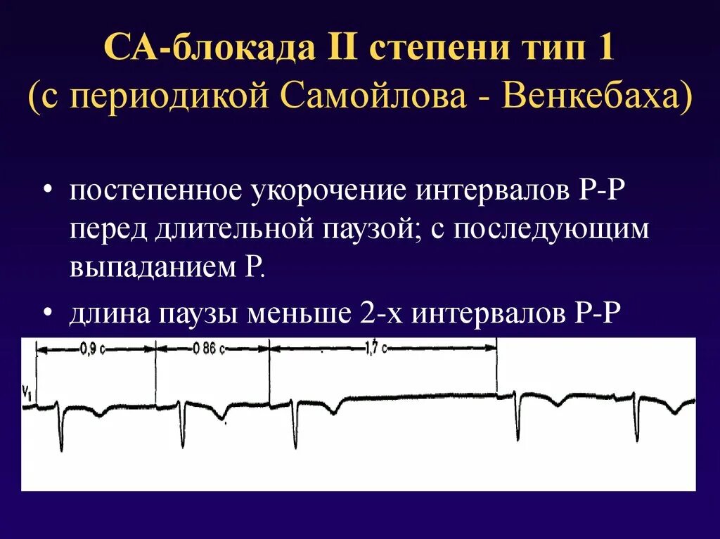 Са блокада типы. Синоатриальная блокада II степени Тип 1. Са блокада 2 степени 1 типа с периодикой Самойлова-Венкебаха. Са блокада 2 степени Мобитц 1 на ЭКГ. Синоатриальная блокада 2 на ЭКГ.