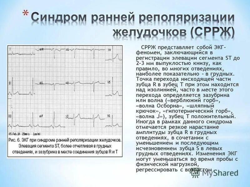 Умеренные изменения процесса реполяризации. Реполяризация миокарда желудочков ЭКГ. Ранняя реполяризация желудочков на ЭКГ. Синдром ранней реполяризации миокарда. Нарушение реполяризации на ЭКГ.