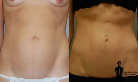 Go to Mini Tummy Tuck. 