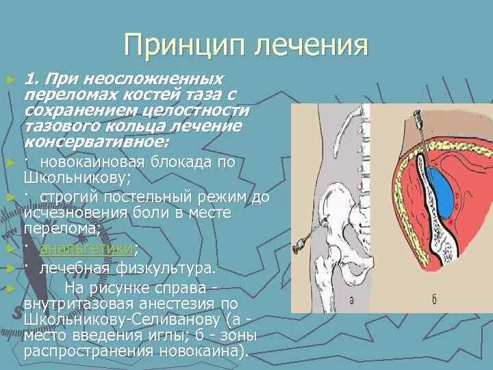 Блокады половые. Техника внутритазовой блокады по Школьникову Селиванову. Тазовою анестезию по Школьникову - Селиванову. Внутритазовая анестезия по Школьникову-Селиванову. Тазовая блокада по Школьникову Селиванову.