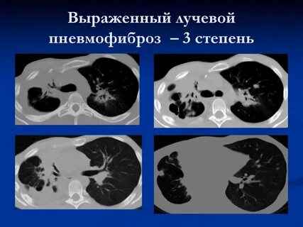 Легкие после лучевой терапии