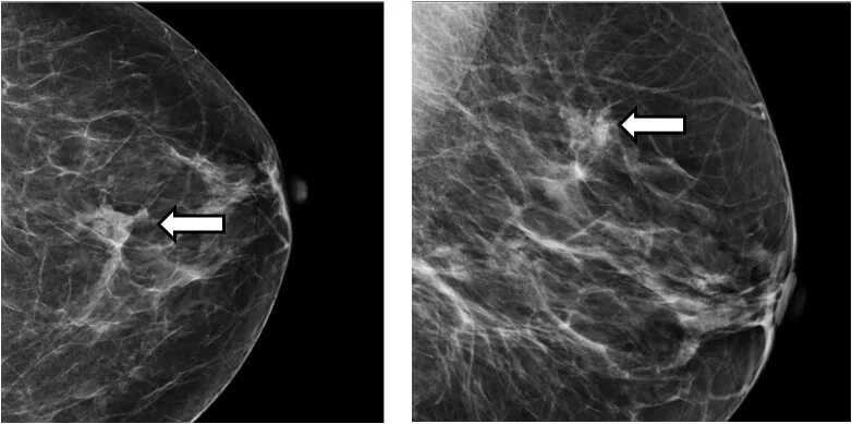 Доле груди. Маммография микрокальцинаты. Кальцинаты на маммографии. Фиброаденома молочной железы маммография. Протоковая карцинома молочной железы маммография.