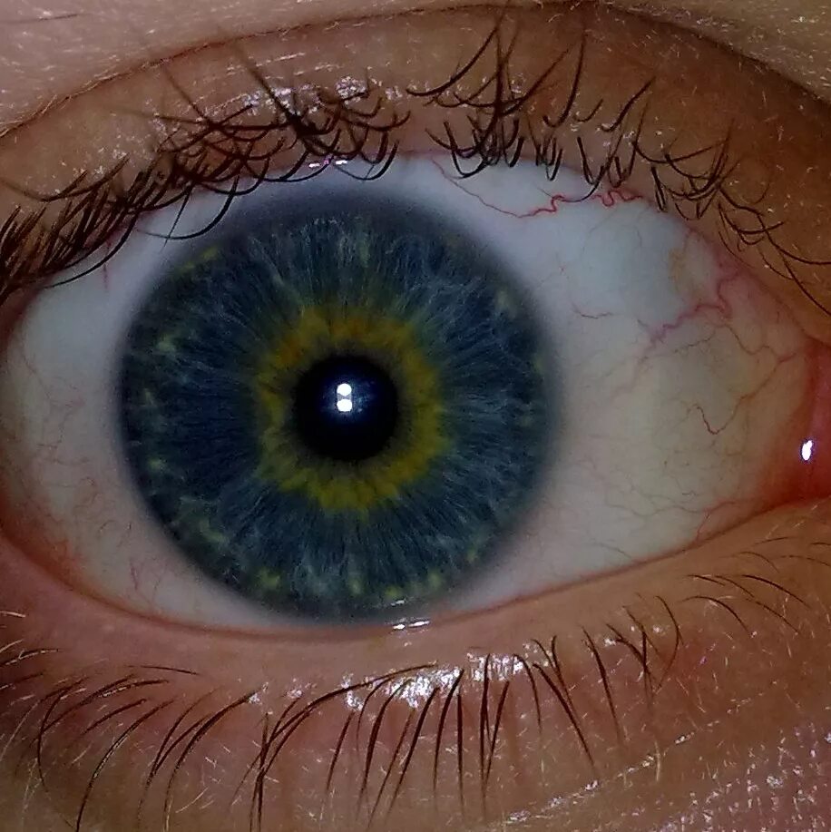 Почему желтым цветом глаз. Центральная гетерохромия голубых глаз. Центральная гетерохромия карих глаз. Центральная гетерохромия хамелеон. Гетерохромия Радужки глаз.