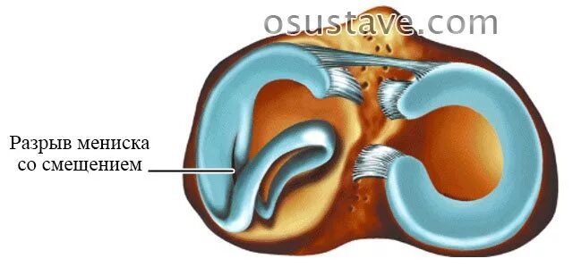 Типы разрывов мениска. Разрыв мениска коленного по типу ручка лейки. Разрыв ручка лейки мениска коленного. Разрыв медиального мениска по типу ручки лейки. Разрыв наружного мениска коленного сустава по типу ручки лейки.