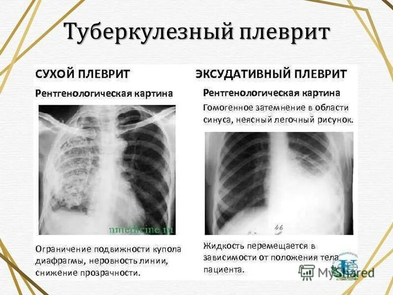 Плевральные осложнения. Туберкулезный сухой плеврит рентген. Туберкулезный экссудативный плеврит рентген. Экссудативный плеврит рентгенография. Экссудативный плеврит т.