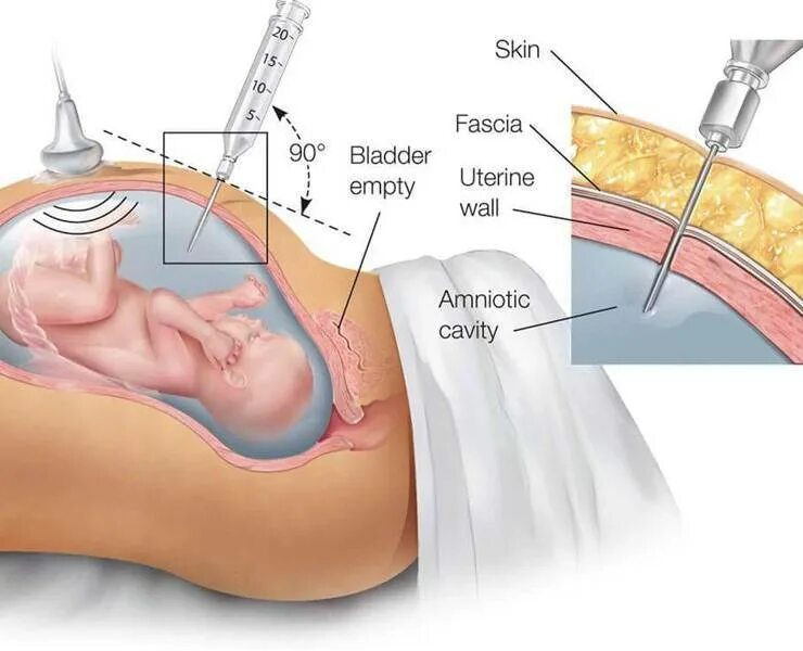 Биопсия хориона амниоцентез кордоцентез. Исследование околоплодных вод амниоцентез. Пункция околоплодной жидкости. Пункция амниотической оболочки. Сколько роды после прокола пузыря
