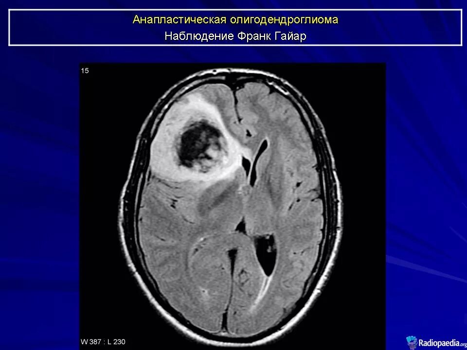 Анапластическая олигодендроглиома. Олигодендроглиома мрт. Олигодендроглиома гистология. Олигодендроглиома Grade 3. Глиальная опухоль головного