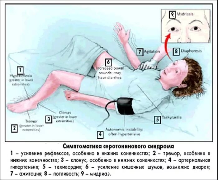 Серотониновый синдром что это такое. Фенитониновый синдром. симптомы серотонинового синдрома. серотониновый синдром симптомы. злокачественный серотониновый синдром.