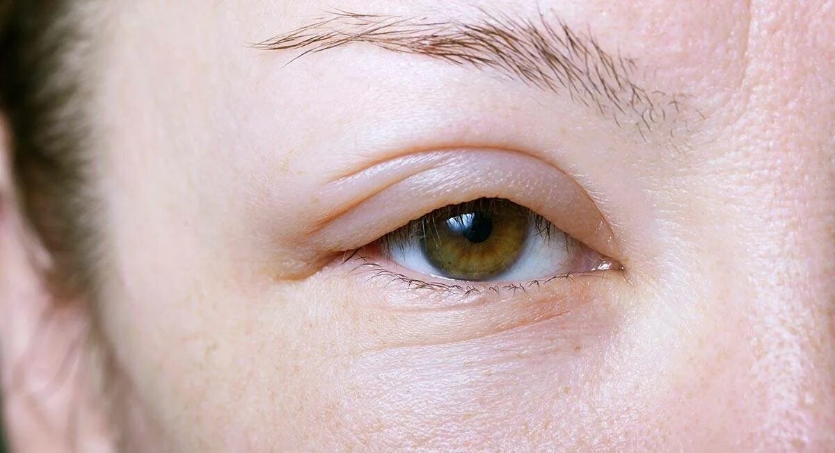 Отекшие глаза причины и лечение у женщин. Опух глаз верхнее веко.