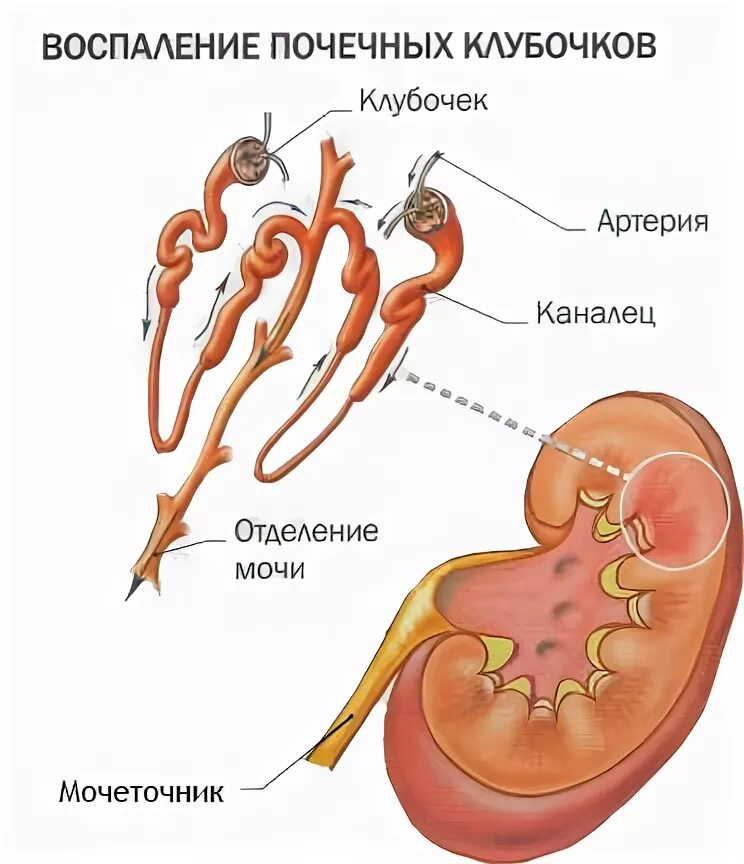 Гломерулонефрит у пожилых. Гломерулонефрит почечный клубочек. гломерулонефрит воспаление клубочков почки. почка пораженная гломерулонефритом. клубочек почки при гломерулонефрите.