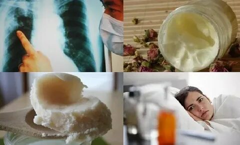 Лечение туберкулеза жирами