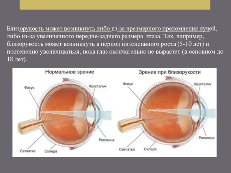 Нормальное зрение и миопия. Зрительные иллюзии акиоши китаока. Фокус зрения. Схема глаза при дальнозоркости. Оптическая система нормального глаза.
