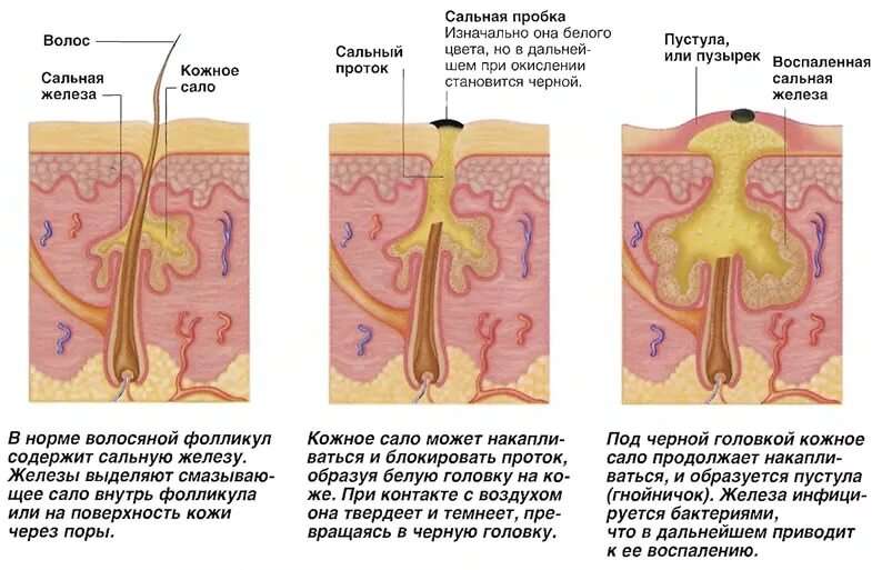 Акне кожа схема сальные железы. Схема кожи сальная железа. Сальная железасальня железа. Воспаленная закупоренная сальная железа.