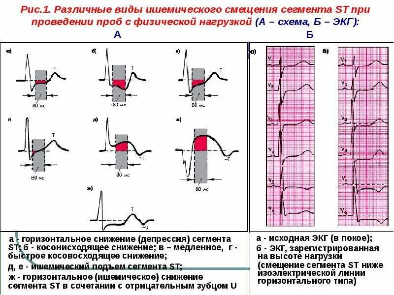 Депрессия сегмента st. Косонисходящая депрессия сегмента St. Депрессия сегмента ст на ЭКГ. Горизонтальное смещение сегмента St на ЭКГ. Горизонтальная депрессия сегмента St до 1 мм.