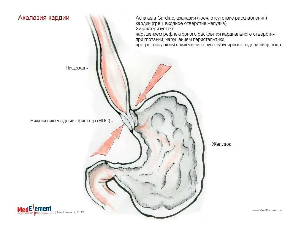 Кардия не смыкается что это значит. Недостаточность кардиального жома симптомы. Кардия желудка недостаточность кардии. Стеноз кардиального отдела желудка рентген.