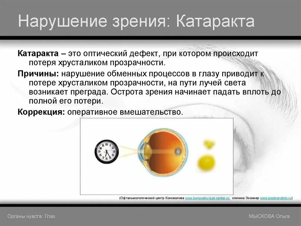 Плохо вижу вдали. Нарушение зрения. Нарушение зрения близорукость. Нарушение зрения катаракта. Нарушение зрения астигматизм.