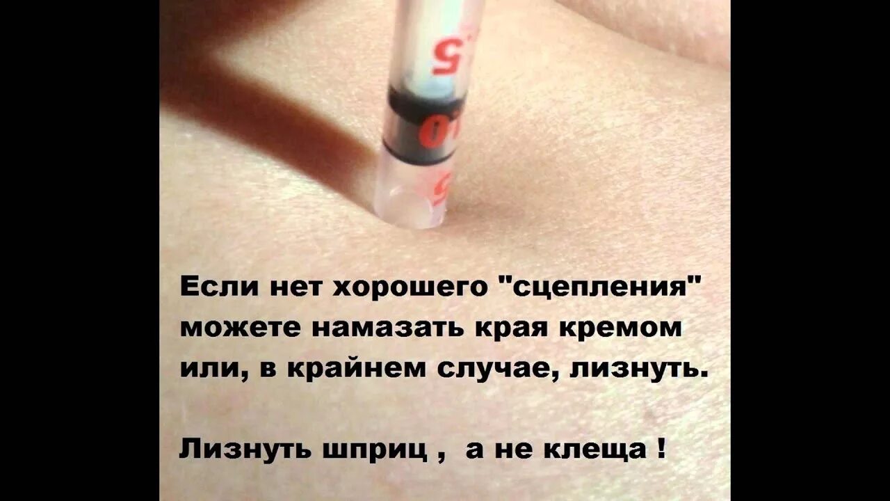 Как вытащить клеща с помощью шприца. Извлечение клеща с помощью шприца. достать клеща с помощью шприца. вытащить клеща с помощью шприца. как убрать клеща с помощью шприца.