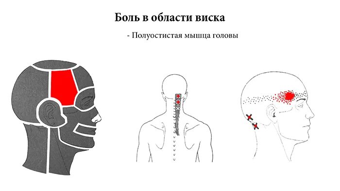 Височная боль с левой стороны