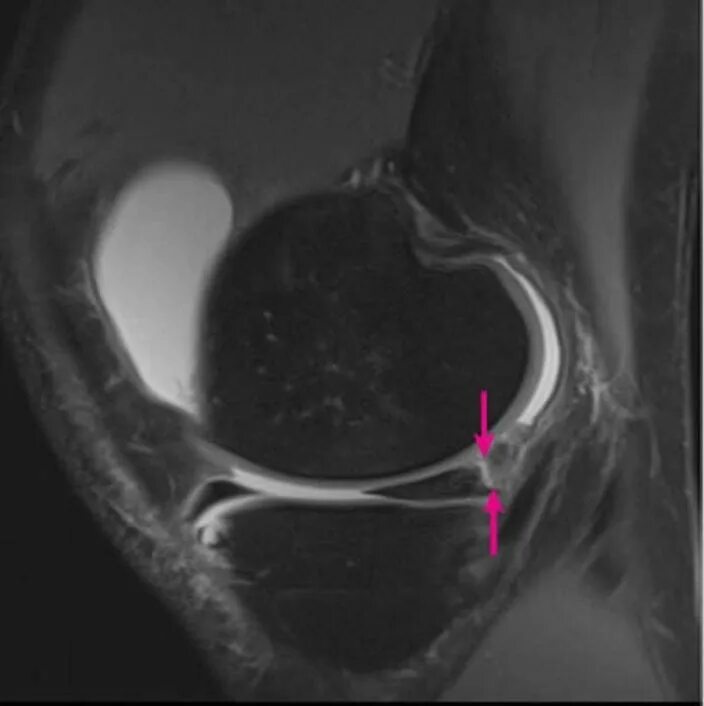 Разрыв рога медиального мениска коленного сустава заднего. Мениско капсулярная сепарация что это. Мениска капсулярный разрыв на мрт. Капсулярная контрактура мрт.