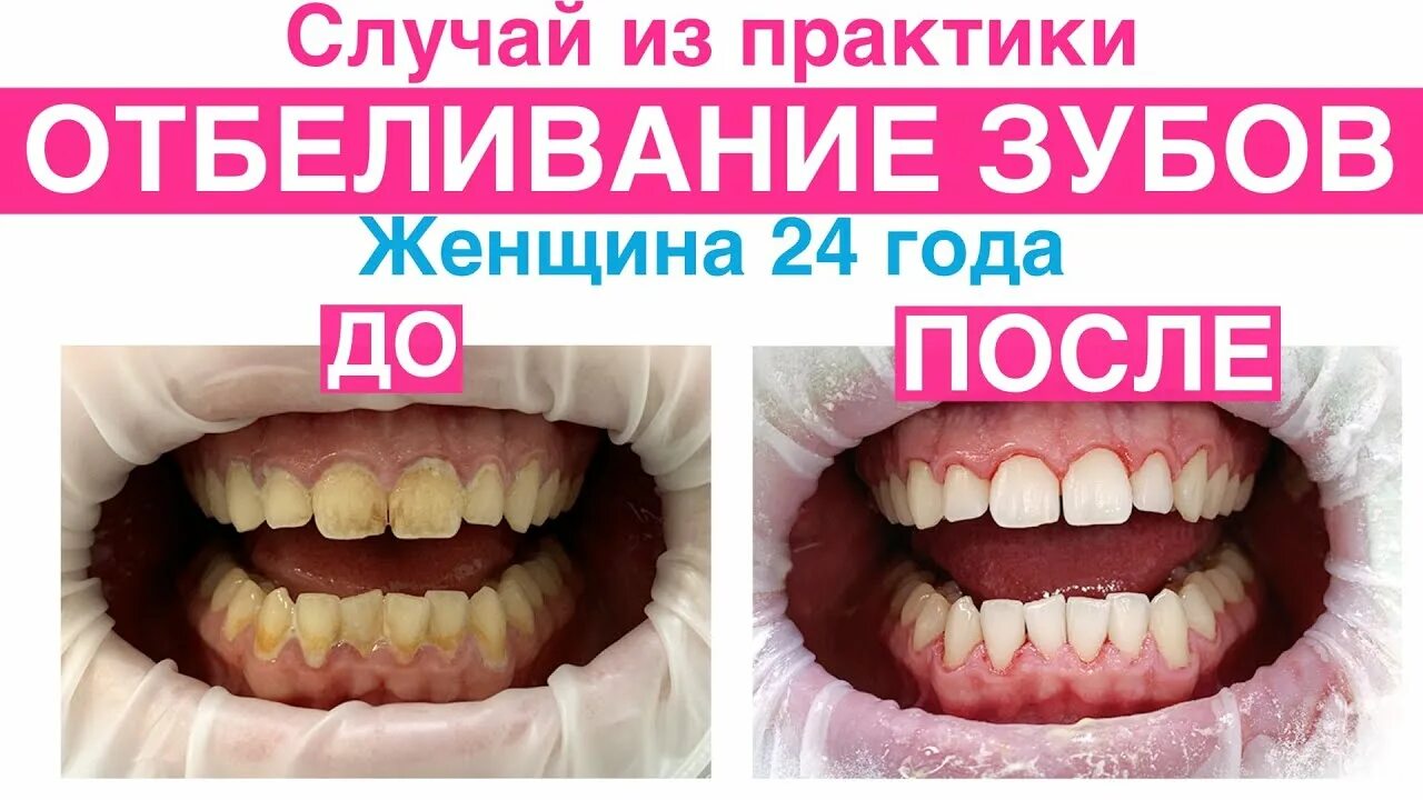 Внутреннее отбеливание