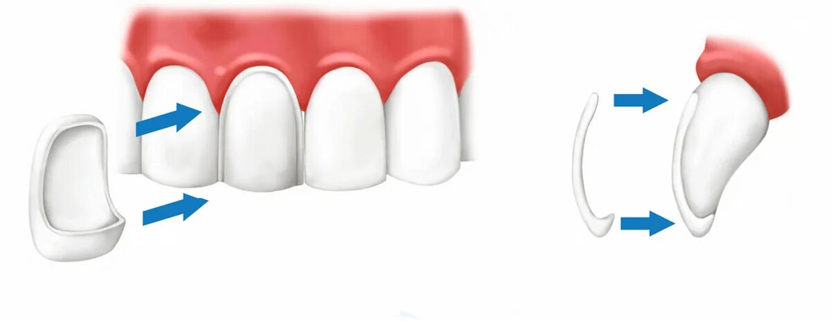 препарирование под виниры. препарирование культи зуба. винир зуб препарирование. препарипрвание под винир. препарирование под винир.