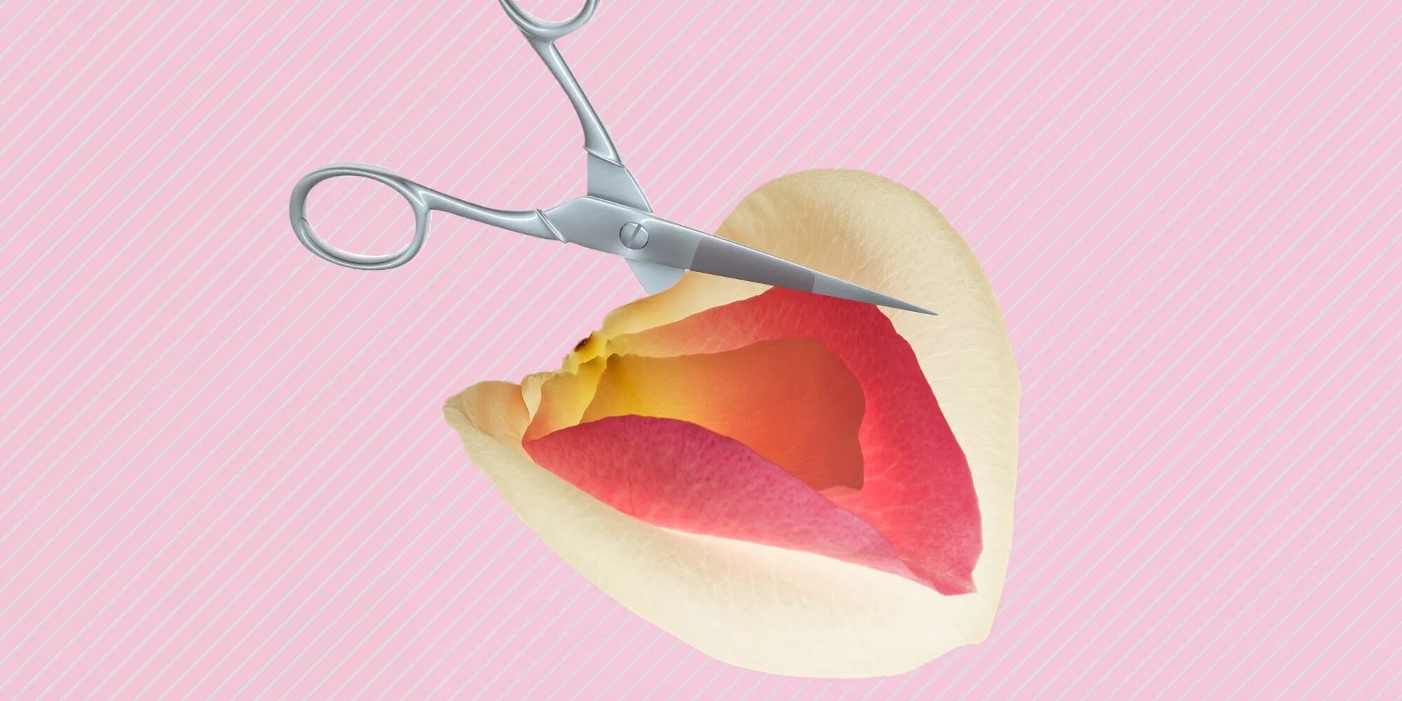 Лабиопластика Эстетика. Пластика малых половых губ (лабиопластика. Что такое лабиопластика в гинекологии. Половые губы снизу