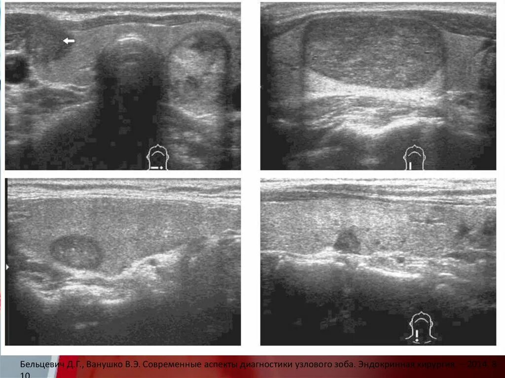 Узловой зоб щитовидной железы на УЗИ. Эндемический Узловой зоб УЗИ. УЗИ щитовидной железы эндемический зоб. Узловые образования щитовидной железы на УЗИ. Диффузно узловое образование