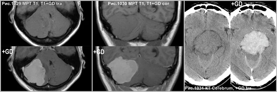 гиподенсивная зона. гиподенсный очаг в печени что это. муцинозная кистозная опухоль поджелудочной железы кт. нодулярная узловая гиперплазия печени. фокальная нодулярная гиперплазия печени на кт.