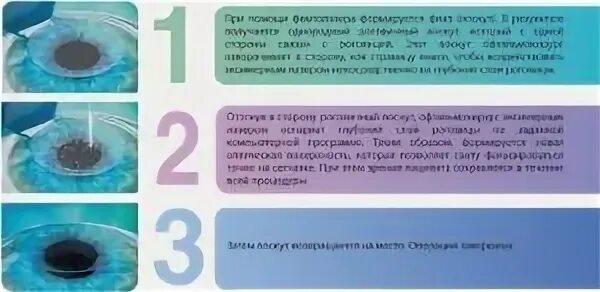 После лазерной коррекции можно сидеть в телефоне. Глаза после лазерной коррекции фемто ласик. принцип лазерной коррекции зрения. лазерная коррекция зрения схема. лазерная коррекция лоскут.