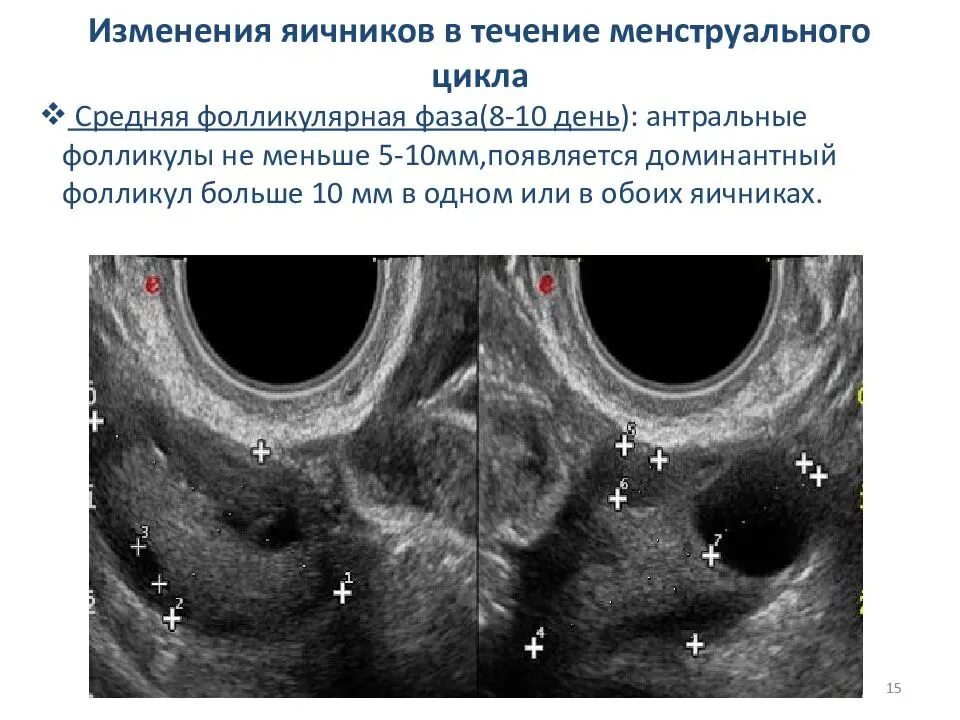 Функции фолликулов яичника. УЗИ мониторинг созревания фолликула. Фолликулы в яичниках 10 мм это норма. Фолликул фаза