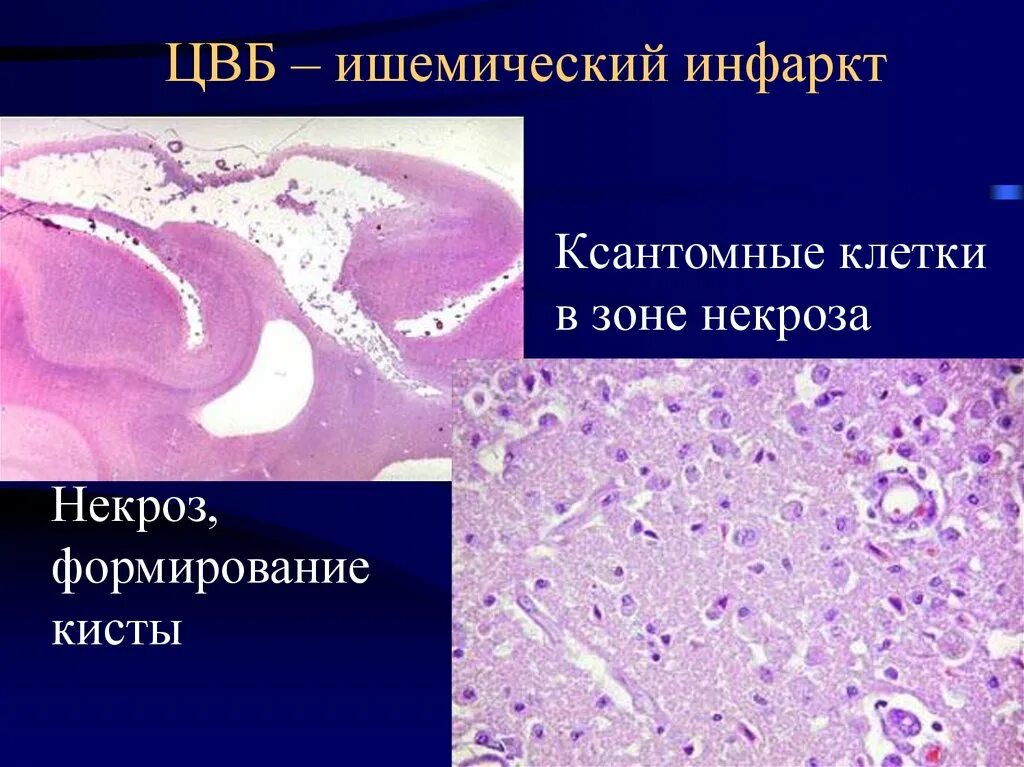 ЦВБ патологическая анатомия. Инфаркт головного мозга Патан. Цереброваскулярное заболевание патанатомия.