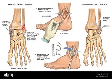 Open fracture