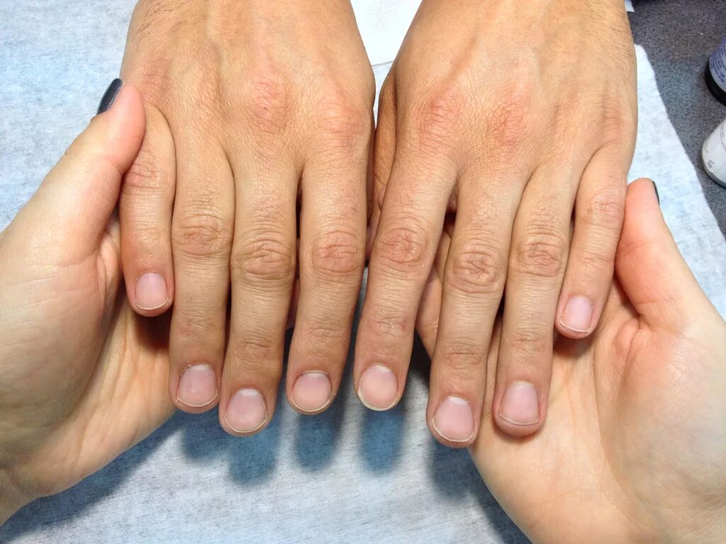 Как выглядят здоровые пальцы рук An interesting case of triphalangeal thumb MEDizzy Journal