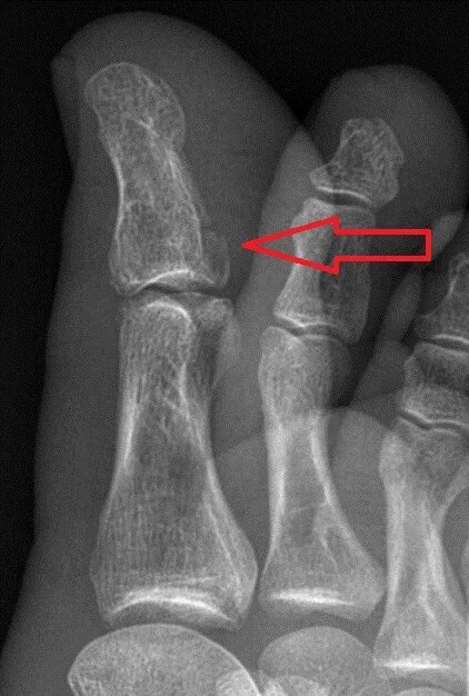 Перелом ногтевой фаланги рентген. Перелом фаланги пальца стопы рентген. Перелом пальца на ноге рентген. Ногтевая фаланга ноги