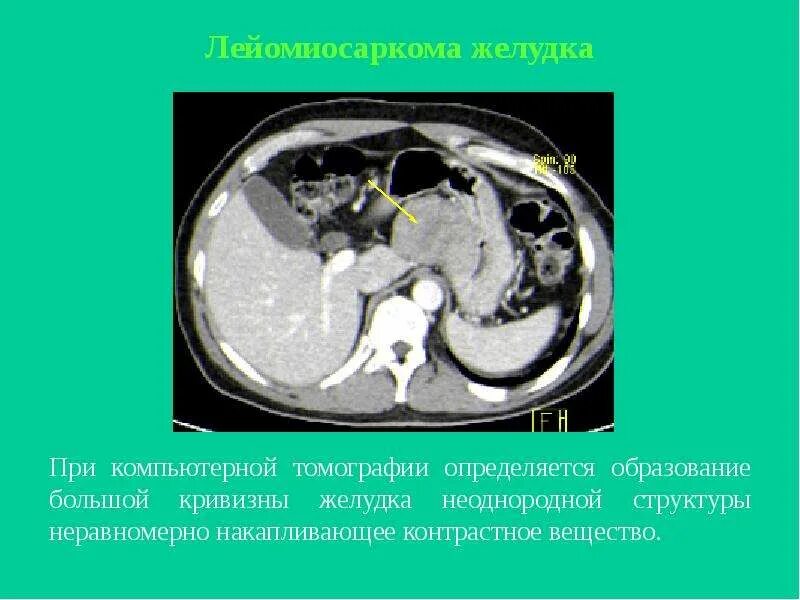 Образование кт. Образование желудка кт. объемное образование желудка на кт.