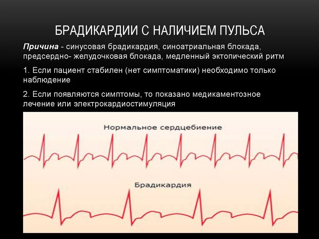 Повышенное давление и тахикардия. Частый и редкий пульс. Заболевания связанные с пульсом. Редкое сердцебиение. ЭКГ при нарушениях ритма сердца.