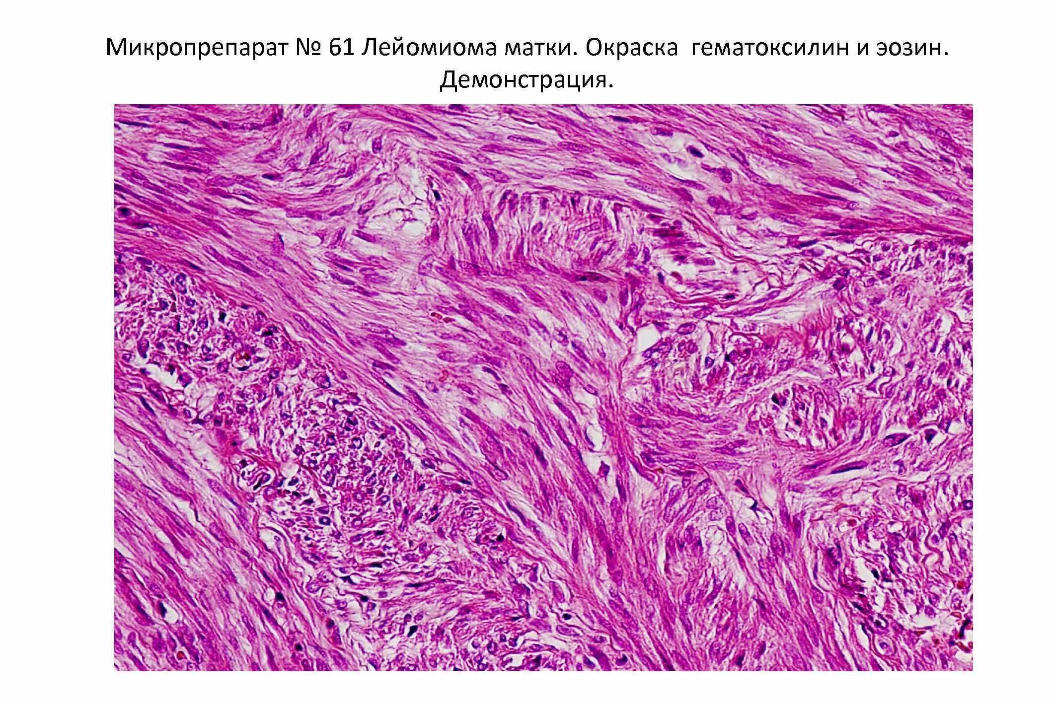 Эндометриальная саркома. Лейомиома матки гистология. Текома яичника гистология. Микропрепарат «клеточная лейомиома матки». Фибромиома матки микро.