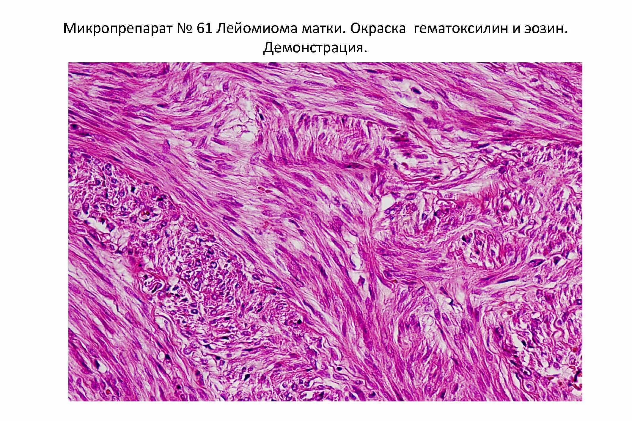 Лейомиома матки гистология. Текома яичника гистология. Микропрепарат «клеточная лейомиома матки». Фибромиома матки микро. Узлы эндометрия