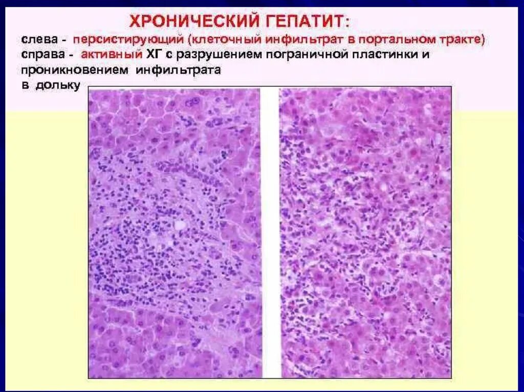 Хронический гепатит печени микропрепарат. Хронический агрессивный вирусный гепатит патанатомия. Хронический активный гепатит гистология. Хронический активный гепатит патанатомия. Печень микропрепарат описание