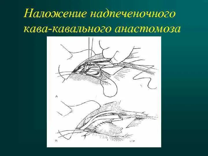 Значение кава кавальных анастомозов. Кавакавальные анастомозы анатомия. порто-кава-кавальный анастомоз. кава-кавальный анастомоз схема. кава кавальные и портокавальные анастомозы.
