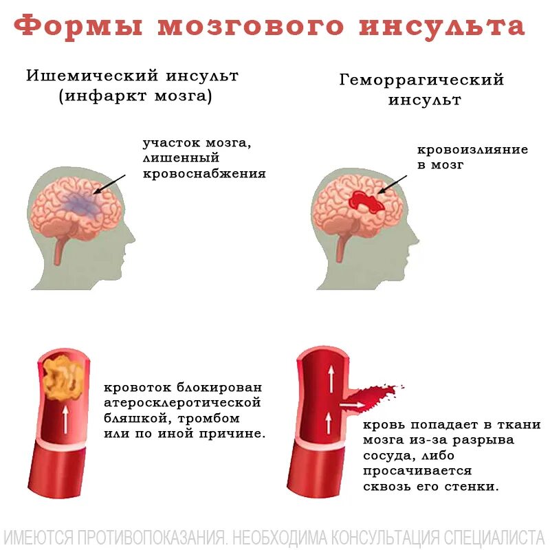 Инфаркт мозга неуточненный