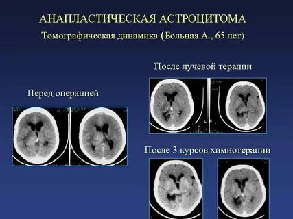 Анапластическая астроцитома