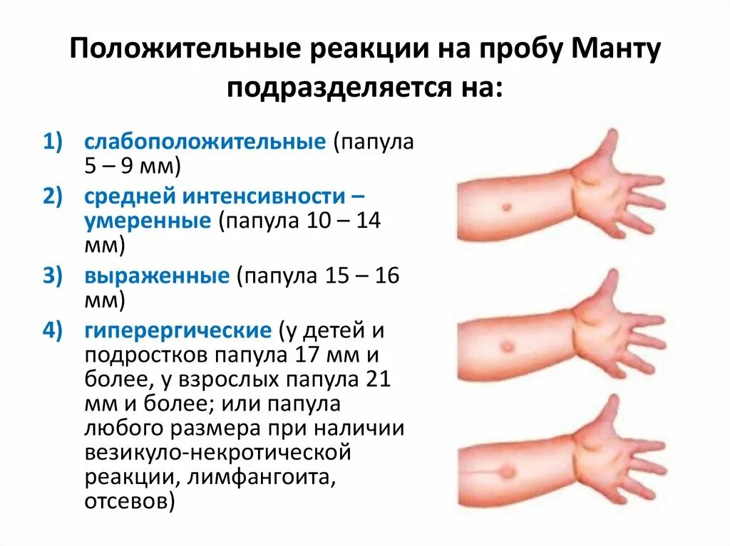 Прививка манту что нельзя делать. Реакция манту норма у детей 12 лет. Туберкулиновая проба манту норма. Туберкулиновая проба диаскинтест нормы. Туберкулиновая проба реакция манту у детей.