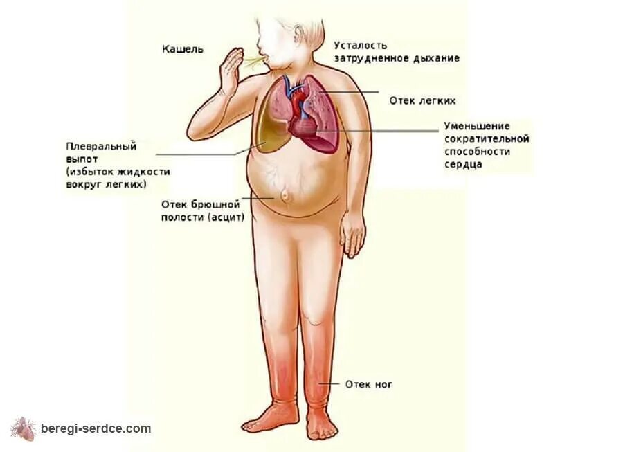 Отеки при хсн. Легочно-сердечная недостаточность причина. Асцит при сердечной недостаточности. Асцит при хронической сердечной недостаточности.