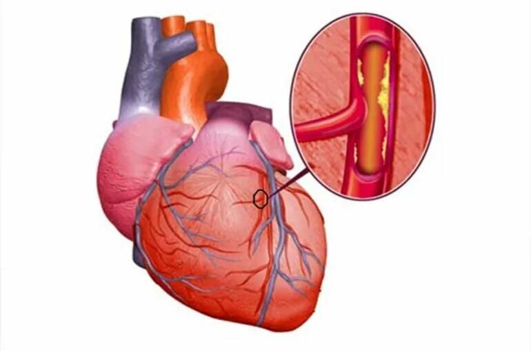 Ишемия давление. 1.1. Ишемическая болезнь сердца. ИБС атеросклеротический кардиосклероз. Атеросклероз ИБС стенокардия. Атеросклероз венечных артерий сердца.