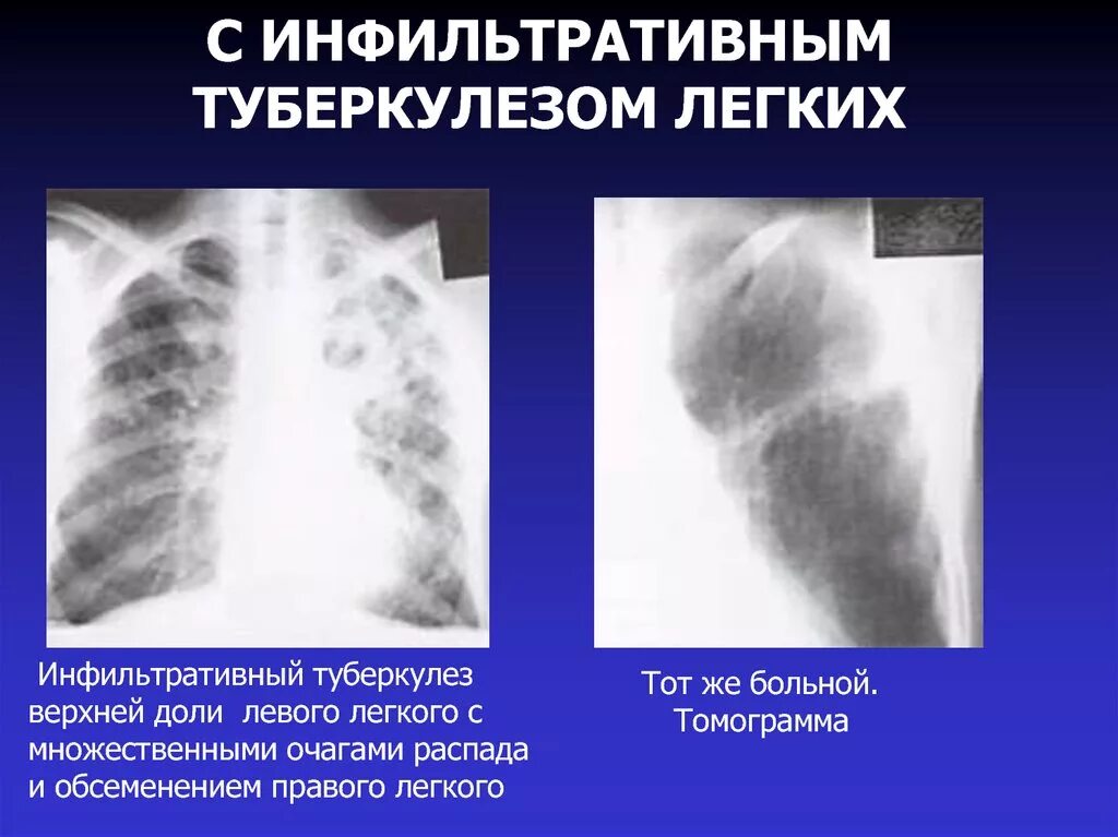 Инфильтративный туберкулез рентгенография. Тотальный инфильтративный туберкулез. Инфильтративный туберкулез рентгенограмма. Инфильтративный туберкулёз инфильтраты.