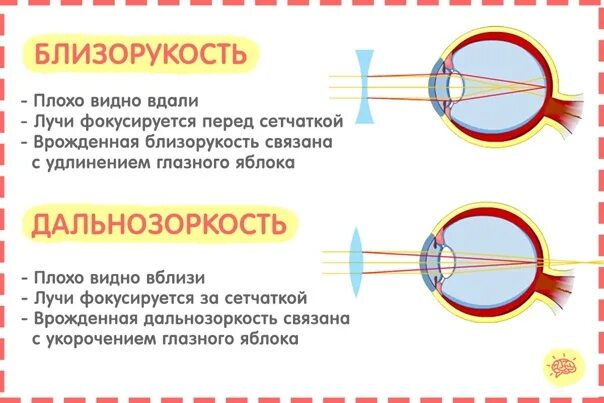 При дальнозоркости изображение предмета фокусируется. Близорукость и дальнозоркость таблица. при миопии изображение фокусируется. близорукость или дальнозоркость. близорукость фокусируется перед сетчаткой.